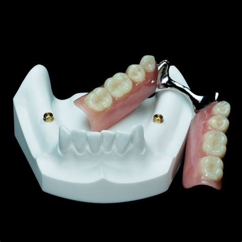 IM-10 Locator Overdenture (2 Zest Abutments over Implants) | Paradigm ...