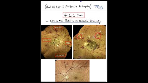 Severe Nonproliferative Diabetic Retinopathy