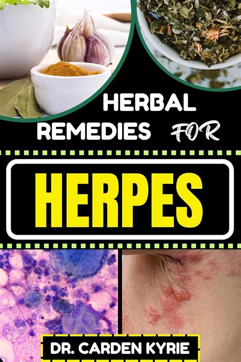 Herbal Remedies For Herpes Unlocking Nature S Healing Power For Targeting Relief