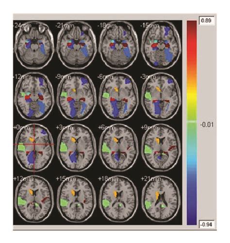 Fifteen Subjects Superposed Average Result Of Correlated Eeg Fmri