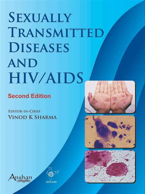 Sexually Transmitted Diseases And Hiv Aids Sharma Vinod K 9781848290198 Books