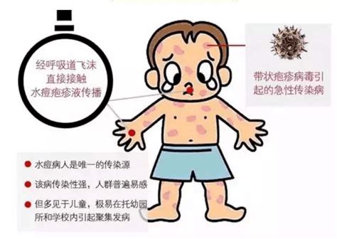 认识水痘一起战痘 症状