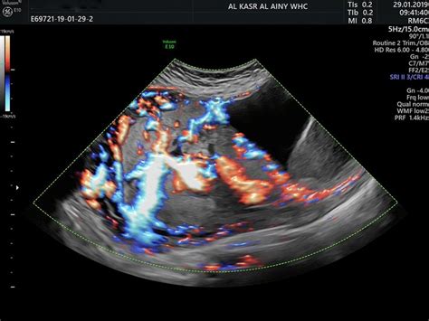 Trans Vaginal 2d Color Doppler Demonstrating Subplacental