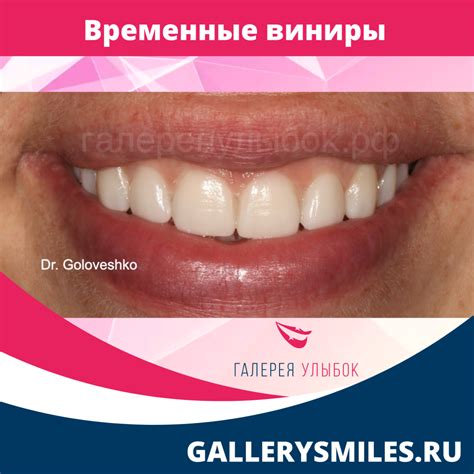 Как выглядят временные виниры?