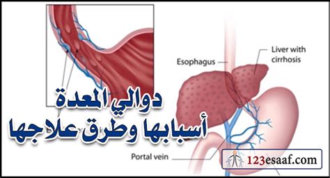 دوالي المعدة أسبابها وطرق علاجها