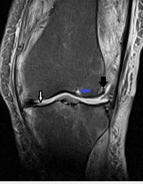 Mri Of The Knee Showing Severe Osteoarthritis White Arrow Showing Download Scientific Diagram