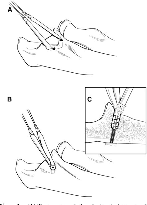 Figure 1 From Strength Of Ulnar Fixation In Ulnar Collateral Ligament Reconstruction A