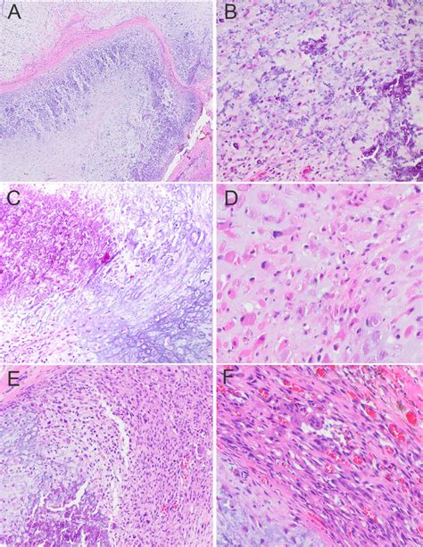 Calcified Chondroid Mesenchymal Neoplasm Report Of A Case Involving