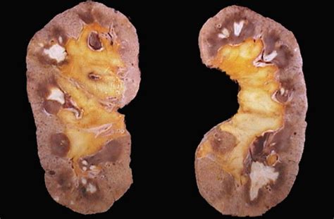 Kidney papillary necrosis; Renal Papillitis, Necrotizing