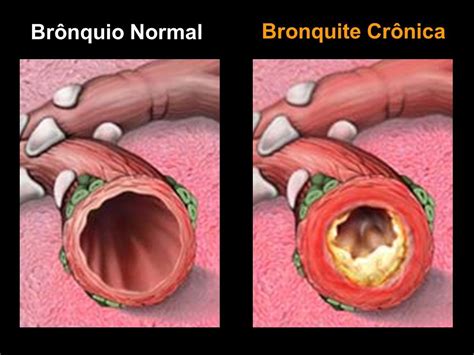 Bronquite Cr Nica O Que Causas Sintomas E Tratamento Cura Natural