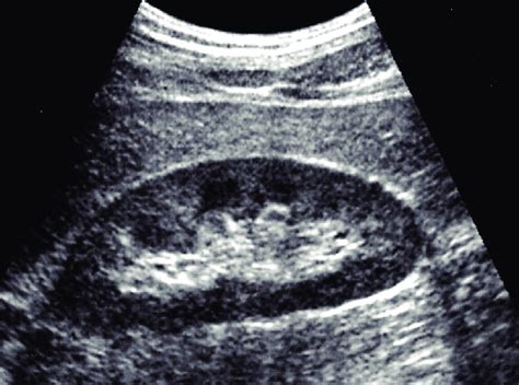 Ultrasonography finding of normal kidney. Figure 2. Simple renal cyst ...