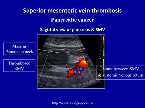 Doppler ultrasound of portal vein thrombosis