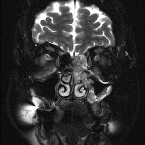 Contrast Enhanced T Weighted Magnetic Resonance Imaging Image