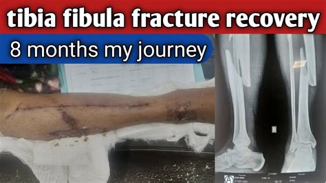 Tibia Fibula Fracture Recovery 8 Months My Journey Mujhy Aaj 8 Mahene