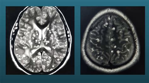 Neurocysticercosis And Myocysticercosis Neuroinfectionsyoutuberadiologyshortsocularcysticerci