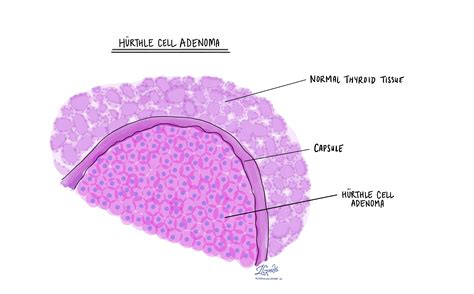 Hurthle cell carcinoma - MyPathologyReport.ca