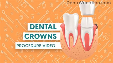 Dental Crowns Procedure DenatVacation YouTube