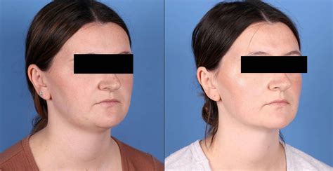 Patient 149385106 | Chin Before & After Photos | Dr. Guy Cappuccino