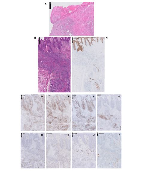 Patient 1 Photomicrograph Of The Incisional Biopsy Hematoxylin And