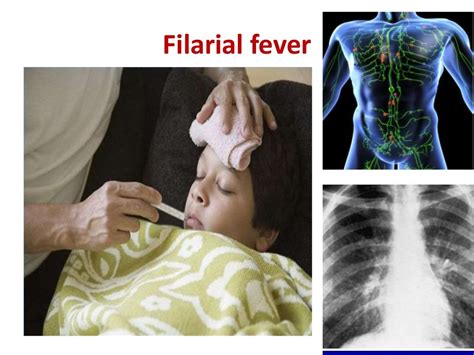 Filarial worms dr. rs 28 08-2017