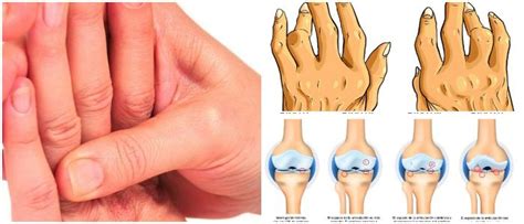 Osteoartritis Que Es Que Estructuras Afecta Sintomas Signos Causas Y