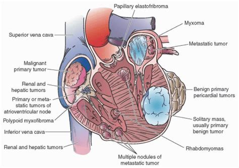 Neoplasms And The Heart Thoracic Key