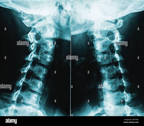 Imagen de rayos X o radiografía de vértebras masculinas humanas del