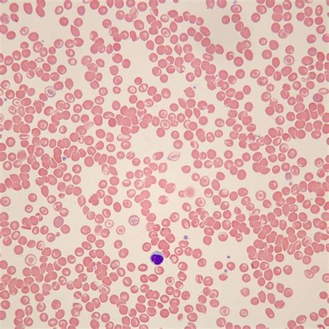 PMS1.341C - Blood, human, sickle cell anemia, smear - Southern Biological