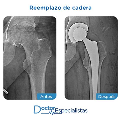 Especialistas En Reemplazo De Cadera Doctor Especialistas