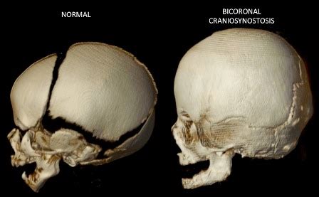 Coronal Craniosynostosis