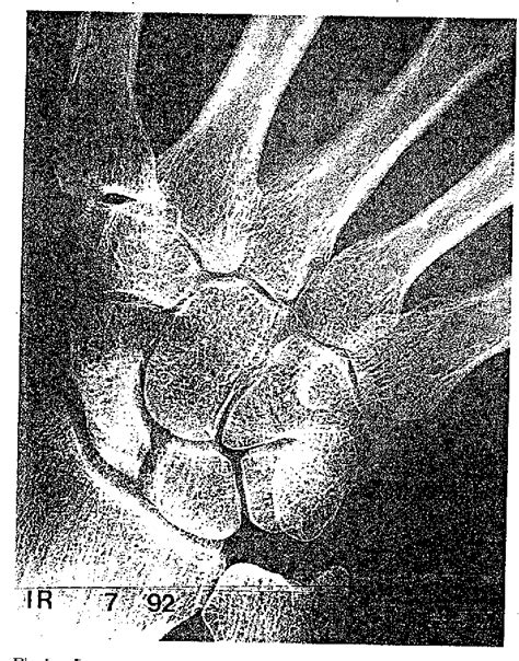 Figure 6 From Idiopathic Avascular Necrosis Of The Scaphoid Semantic