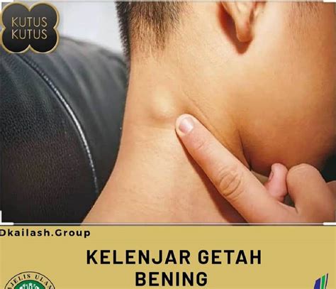 Tanpa Operasi Kenali Penyebab Dan Cara Mengobati Kelenjar Getah Bening