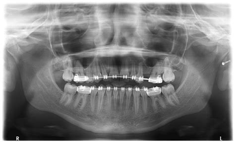 Adenomatoid Odontogenic Tumor