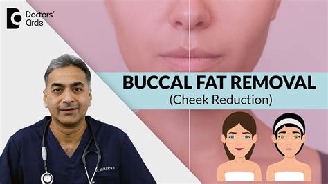 CHEEK FAT REDUCTION Get Thin Cheeks With BUCCAL FAT REMOVAL SURGERY