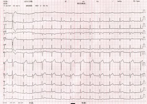 ECG indicates a sinus rhythm and PVCs | Download Scientific Diagram