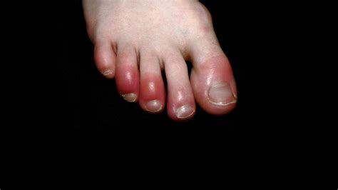 What Is Covid Toe Maybe A Strange Sign Of Coronavirus Infection