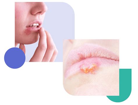 Consult a dermatologist for herpes (oral and genital)