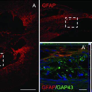 Expression Of Gfap And Gap In The Lesion Site Of Spinal Cord In