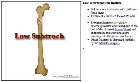 Intramedullary Nail Femur Icd 10 Bios Pics