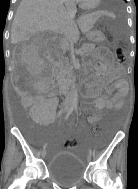 Renal Angiomyolipoma Gross