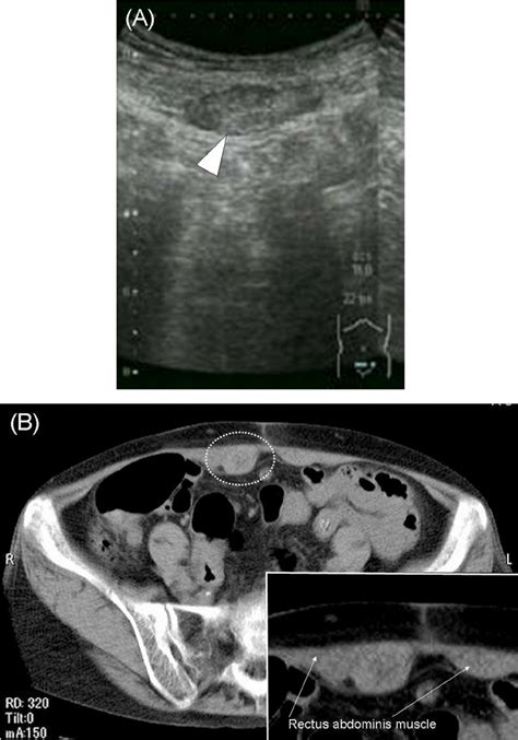 A A Mixed Echogenic Mass Was Seen Within The Rectus Sheath White Download Scientific Diagram