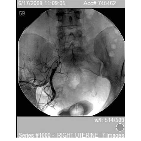 Right Uterine Artery Embolization In A Case Of Cervical Twin