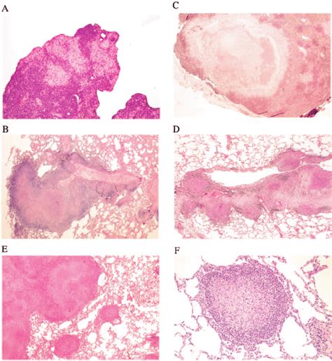 Microscopic pathology of granuloma formation in acute M. tuberculosis ...