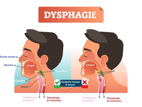 Dysphagie Trouble De La D Glutition Cause Sympt Mes Traitements