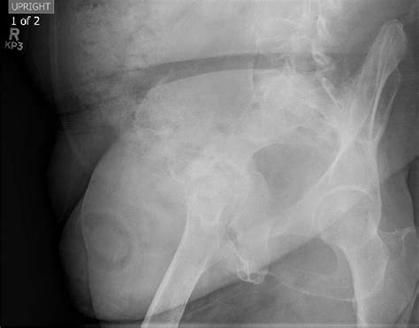 Iliac Bone Anatomy X Ray