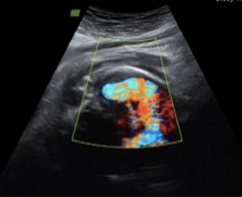 Vascular Structure With A Turbulent Flow Under Color Doppler Ultrasound