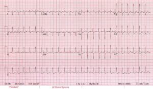 AVNRT LITFL REBEL EM Emergency Medicine Blog