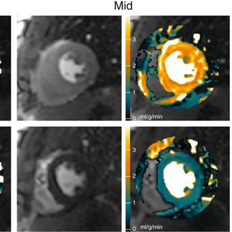 Quantitative Myocardial Perfusion Map Example Of Pixel Maps