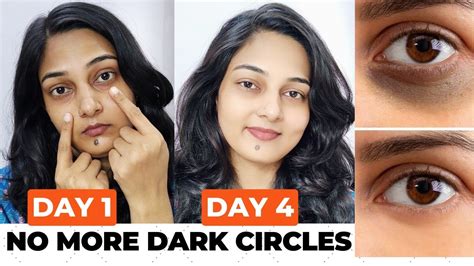 Get Rid Of Dark Circles Naturally In 7 Days How To Remove Dark