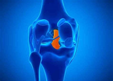 Posterior Cruciate Ligament Pcl Reconstruction Repair Orthopedic